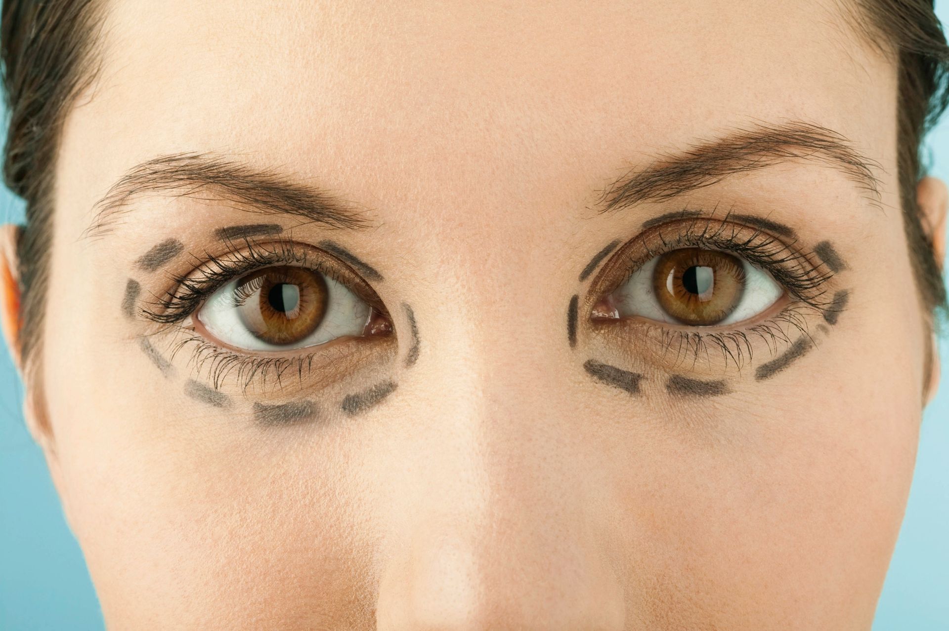 eye lifts