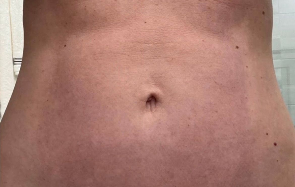 A person's abdomen, skin is pale with a darker shadow along sides and top.