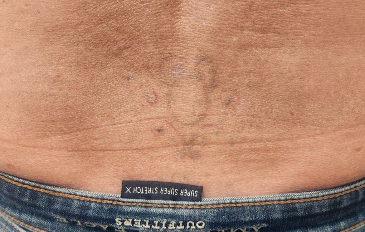 Back of person wearing jeans, skin with dark patches and blemishes visible.