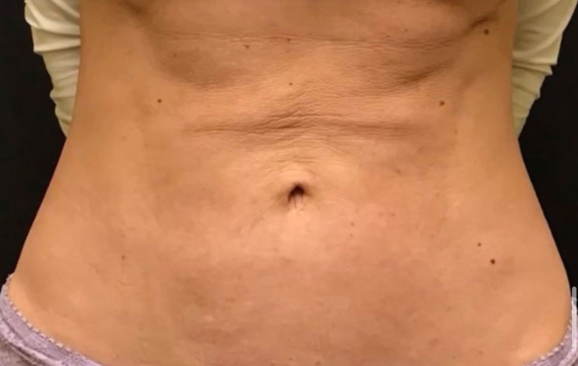 Abdomen with loose skin and slight discoloration. Visible navel and faint lines.