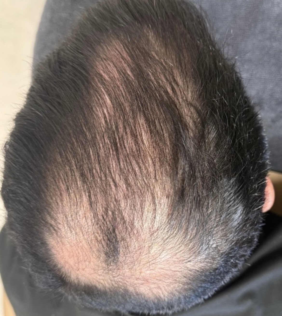 Top view of a head with noticeable hair thinning at the crown and hairline.