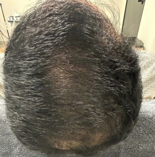 Top view of a person’s thinning dark hair with a visible bald spot on the crown.