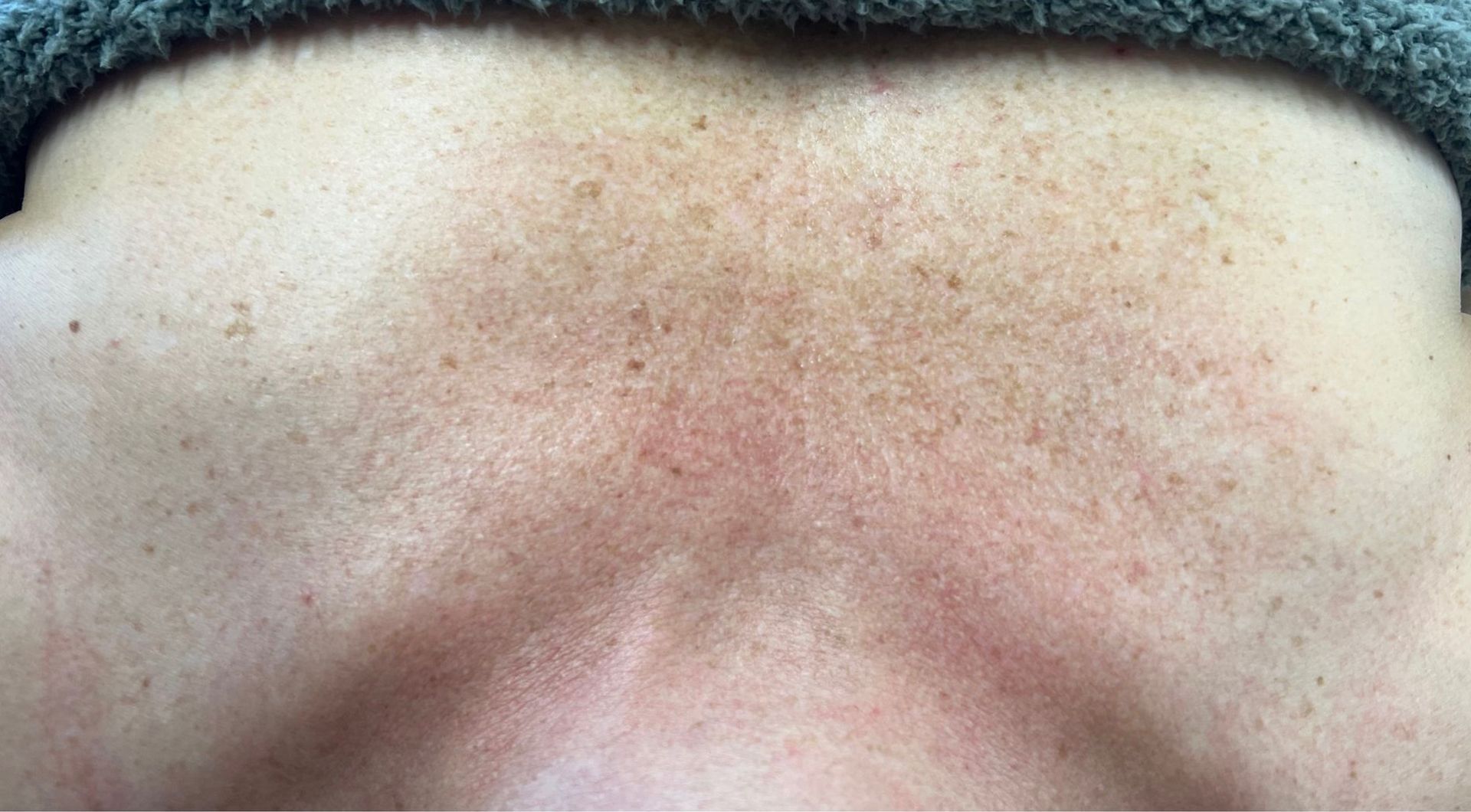 Close-up of human skin, showing a chest area with small spots and reddish discoloration. 
