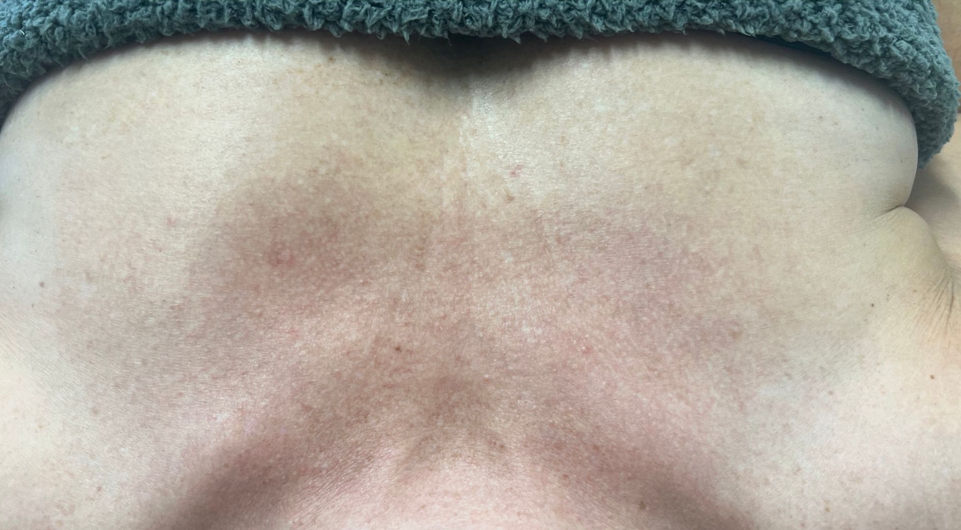 Back with red discoloration, possibly from pressure or irritation. 