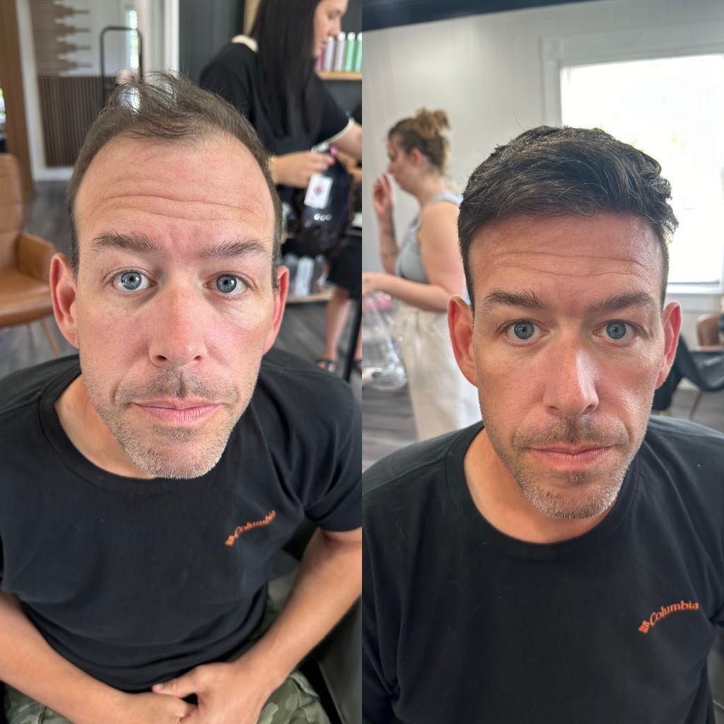 Side-by-side comparison of a man with thinning hair before and after a hair transplant. In both, he wears a black t-shirt and has a serious expression.