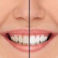 Teeth before cleaning and after cleaning