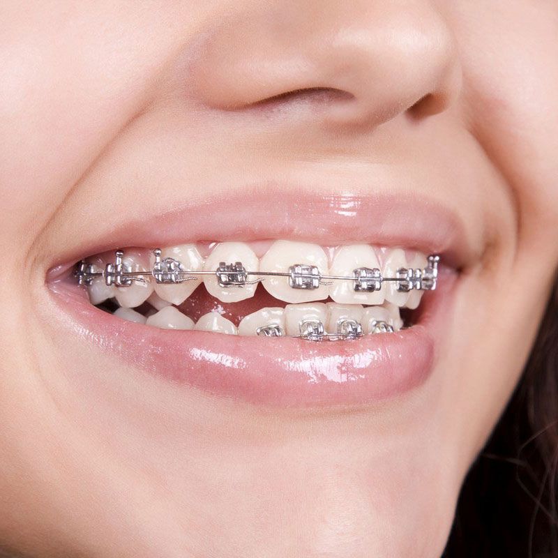 A close up of a woman 's mouth with braces on her teeth