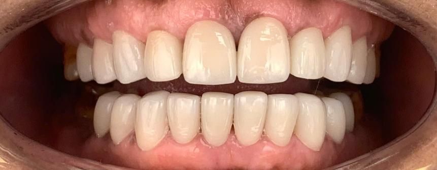 Close-up of a person's mouth showing a full set of white, well-aligned teeth and healthy gums.