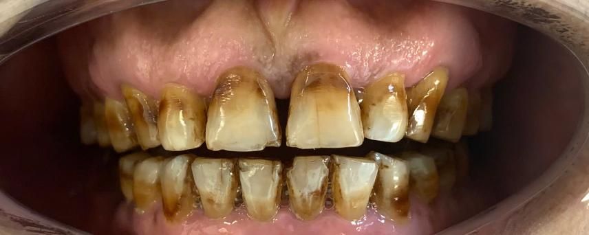 Close-up of human teeth showing significant staining, discoloration, and signs of plaque accumulation.