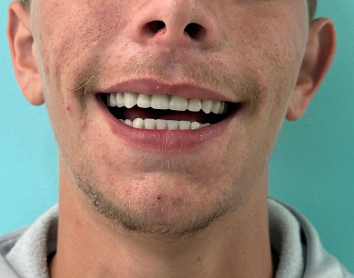 Close-up of a smiling person with visible teeth, a mustache, and a slight stubble