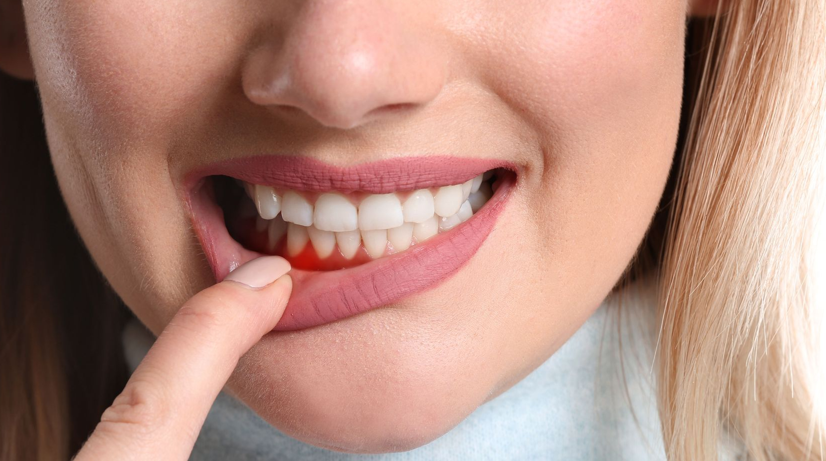 Woman pointing to inflamed, red gums, indicating a possible dental issue.