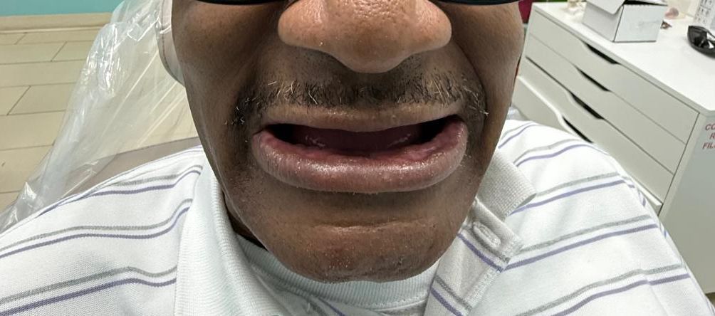 Close-up of a person's open mouth, showing the inside of the lips, with a mustache.