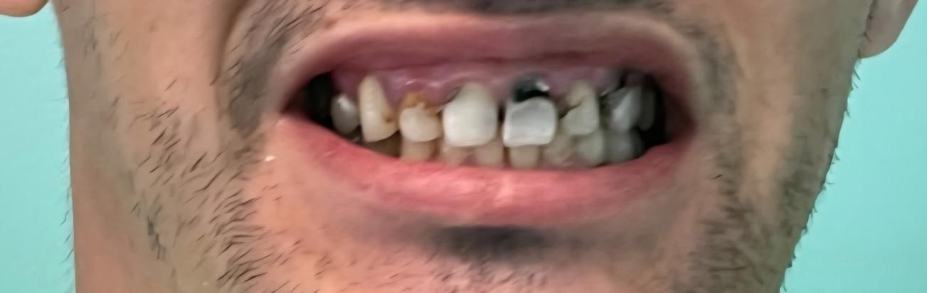 Close-up of a person's open mouth, showing the inside of the lips, with a mustache.