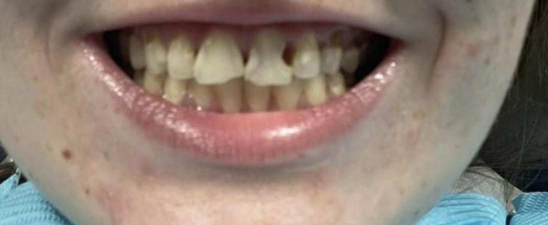 Close-up of a person's open mouth, showing the inside of the lips, with a mustache.