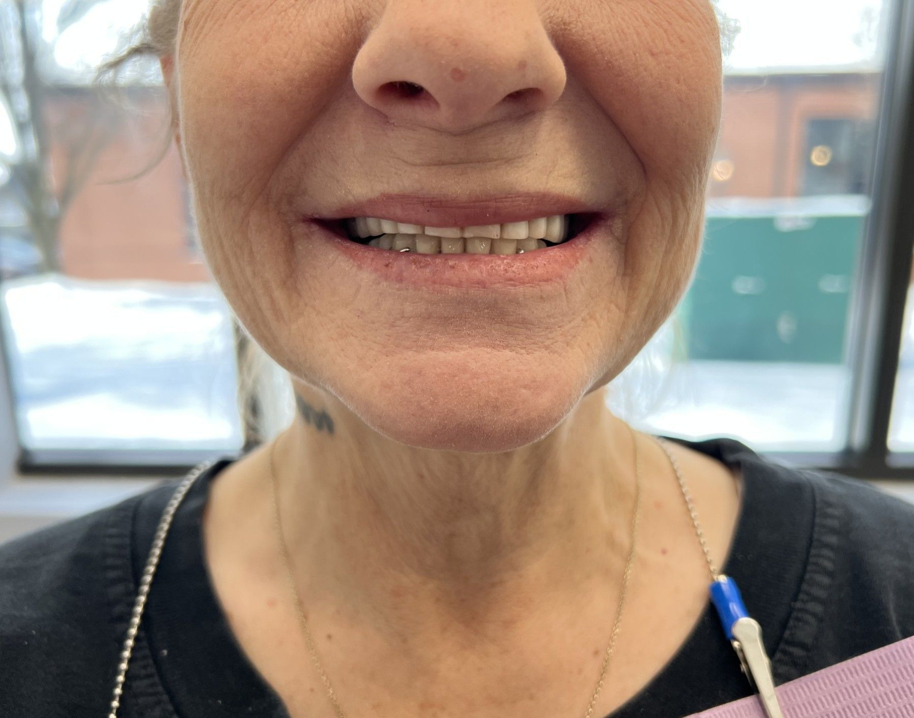 Woman smiling, showing teeth in dental office setting. 