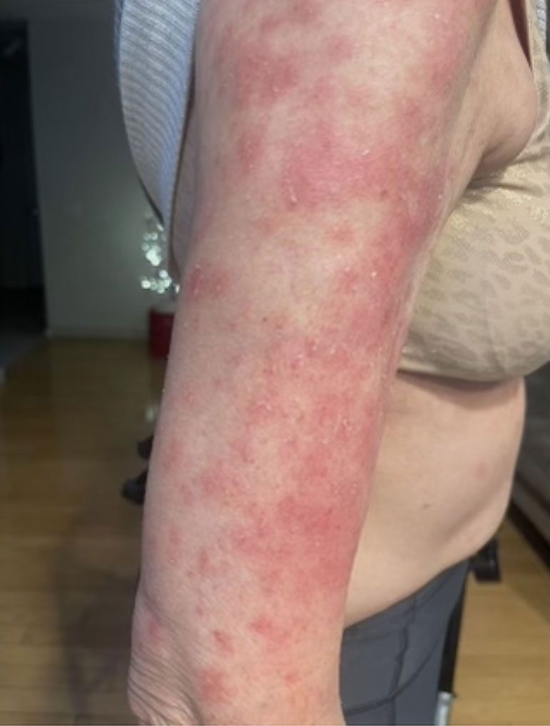 A woman with a rash on her arm is standing in a room