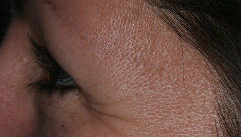 Before Botox Cosmetic