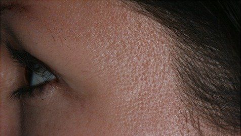 After Botox Cosmetic