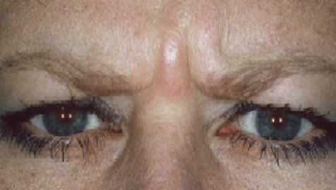 Before Botox Cosmetic