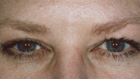 After Botox Cosmetic