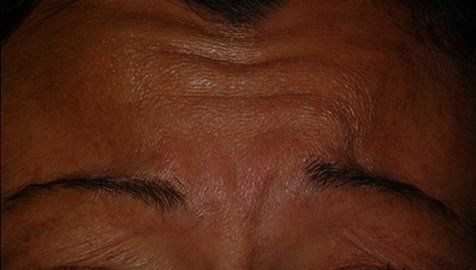 Before Botox Cosmetic