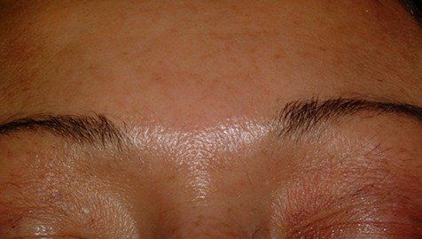 After Botox Cosmetic