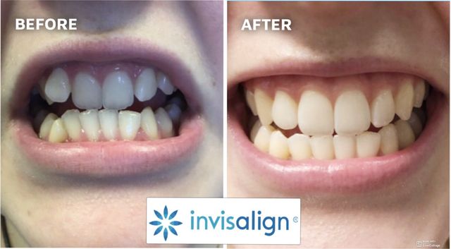 Transform Your Teeth with Clear Aligners: Before and After Pictures