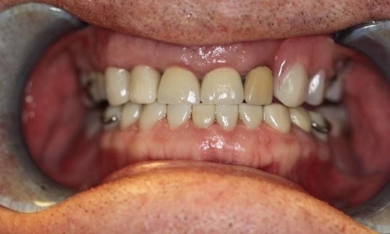 After Crowns and Bridges