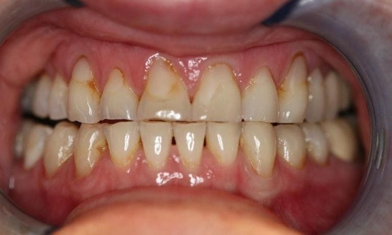 Before Crowns and Bridges