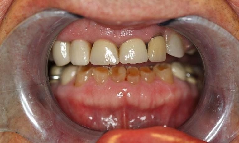 Before Crowns and Bridges