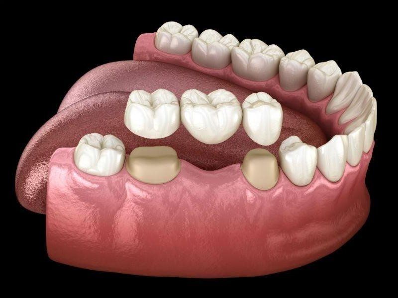 Dental Crowns and Bridges