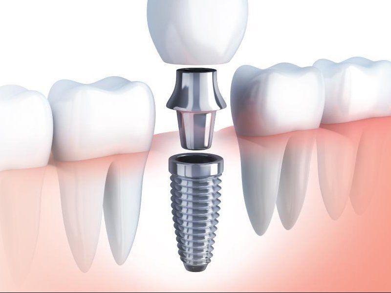 Dental Implant Services