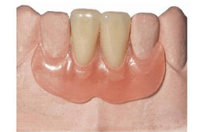 Natural-looking dentures