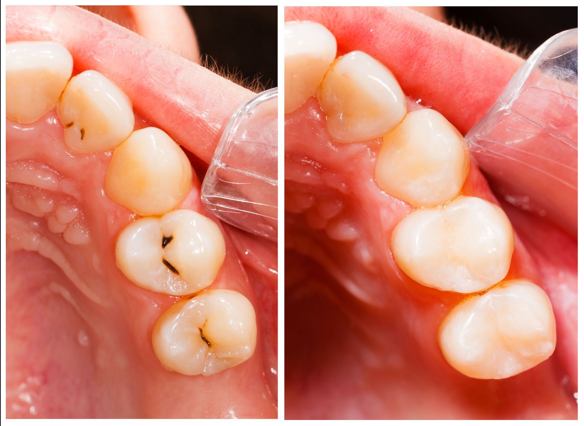 3 Reasons to Get Cavities Treated Right Away