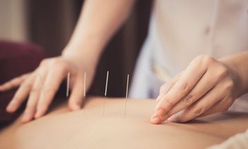 Chinese acupuncture