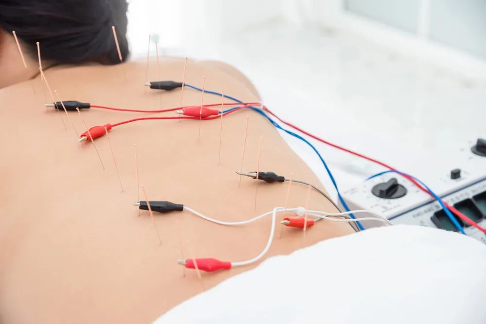 Electro-Neuro Acupuncture