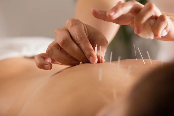 Hands inserting acupuncture needles into a person's back.