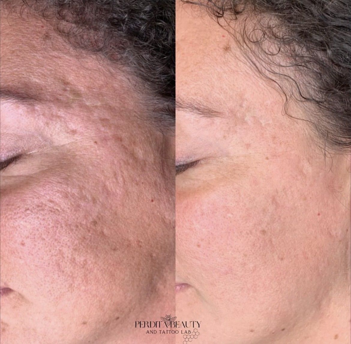 Comparison of a face with severe acne scars before (left) and after (right) a treatment; skin is clearer and smoother on the right.