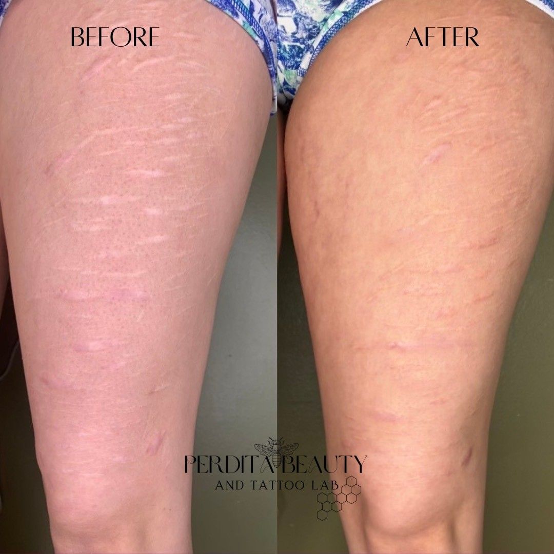 Comparison of a thigh with stretch marks before and after treatment; skin appears smoother, and the stretch marks are less visible.