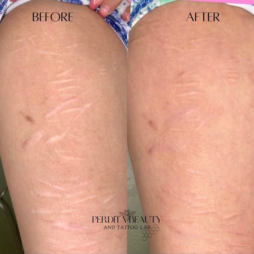 Comparison of a thigh with stretch marks 
