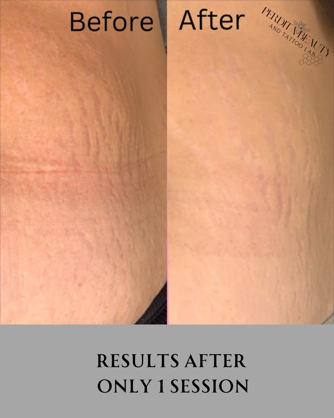A before and after photo of stretch marks on a woman 's thigh
