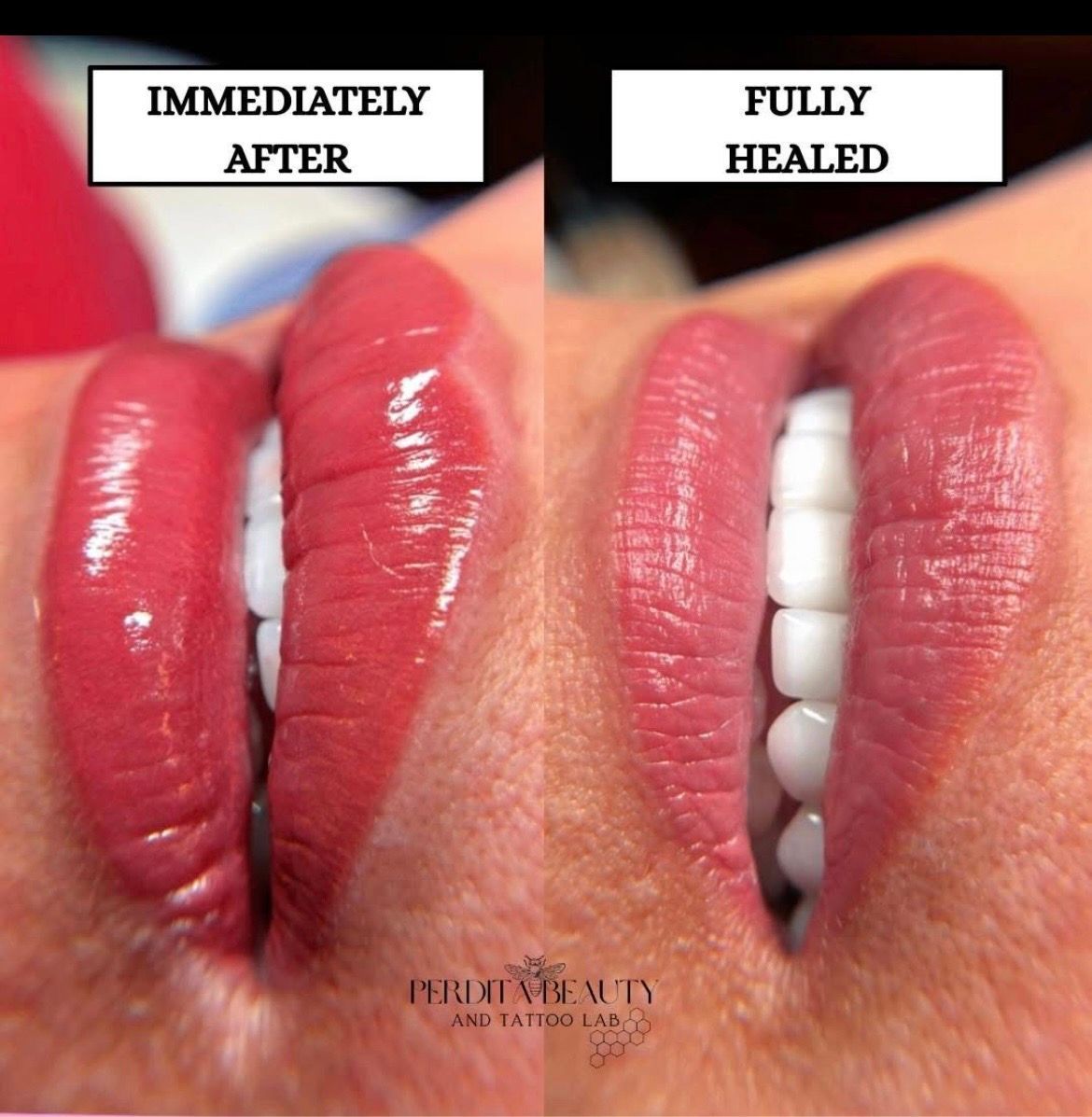 Side-by-side close-up of lips labeled “Immediately after” and “Fully healed,” showing bruising fading to normal.
