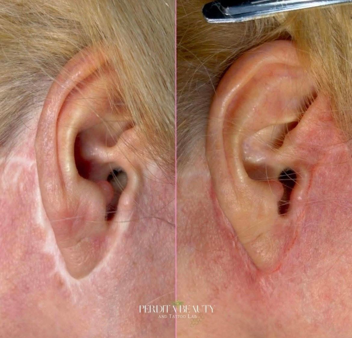 Before-and-after close-up of an ear, showing an ear canal with a darkened opening on the right.