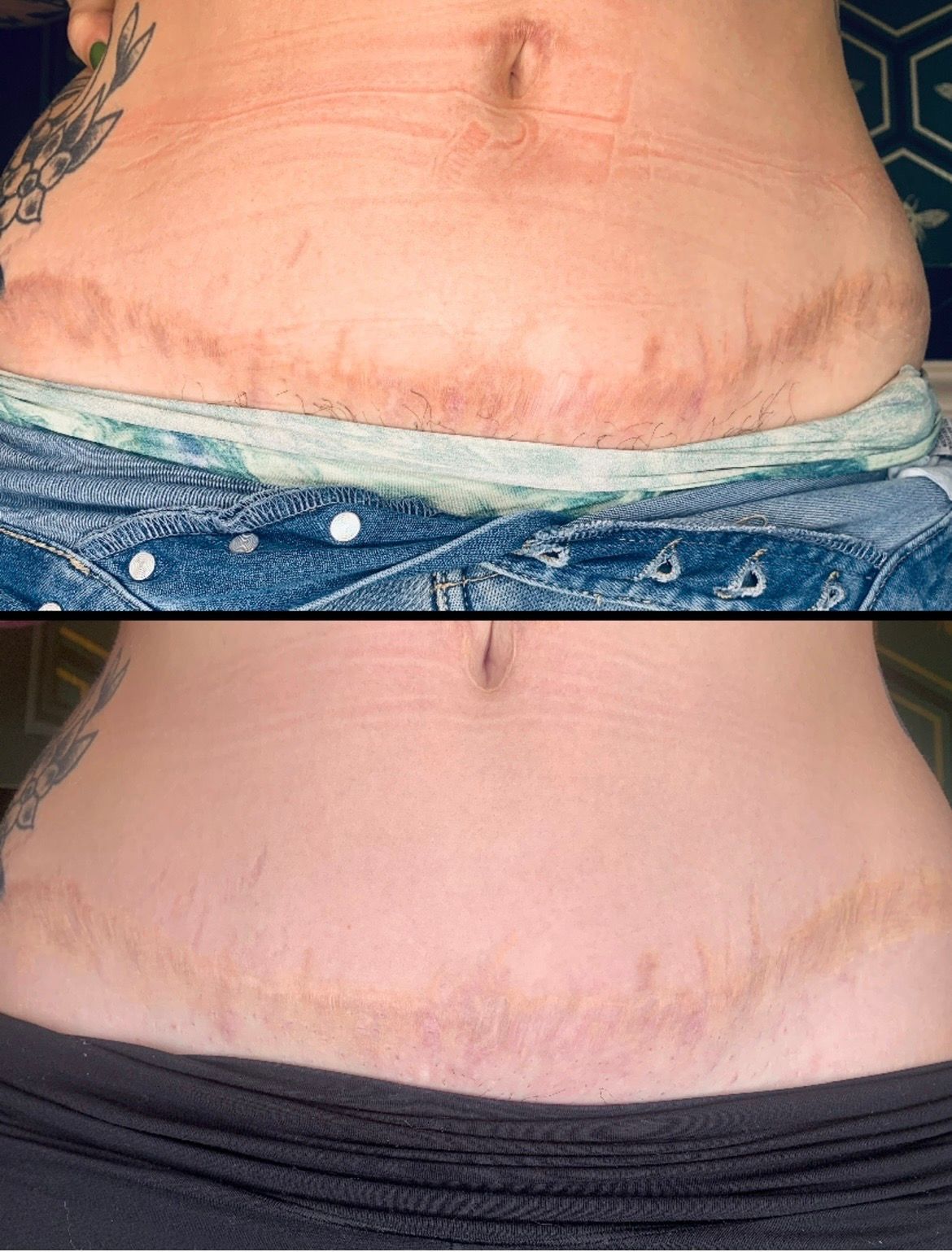 Before-and-after close-up of a bare abdomen, showing a healed horizontal scar above the waistband.