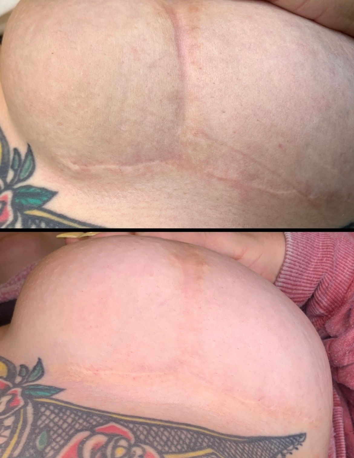 Two close-up photos of skin showing a round, raised bulge near a tattooed area.