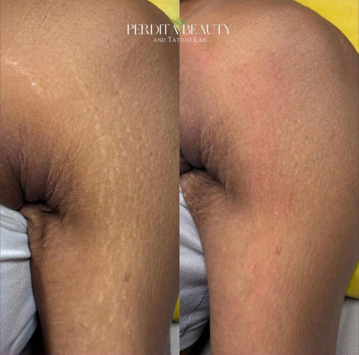 Side-by-side close-up of a bent elbow, showing a before-and-after skin texture comparison.