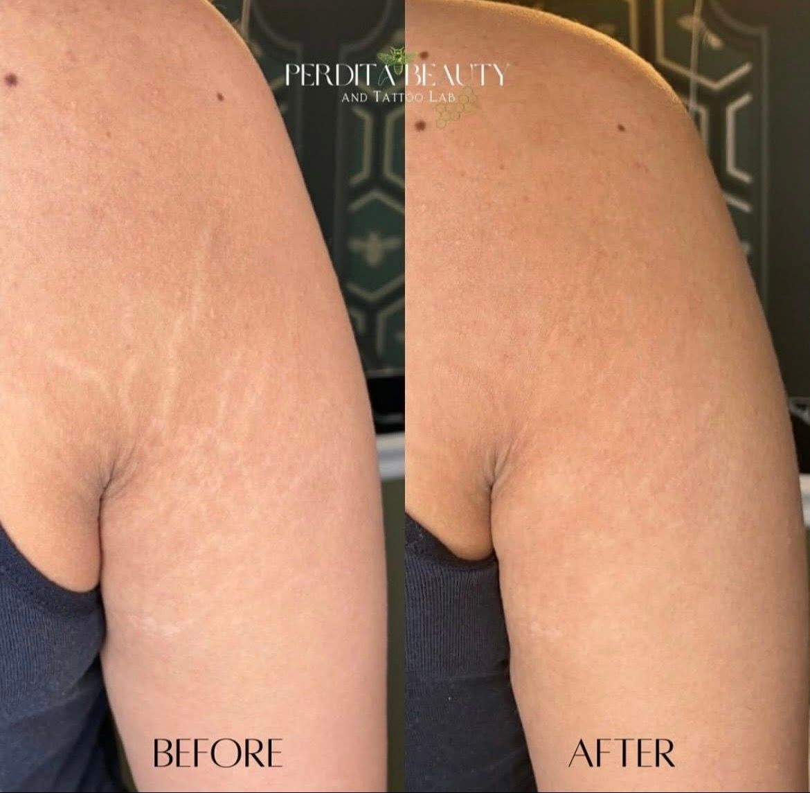 Before-and-after side view of an upper arm, showing smoother skin in the after image.