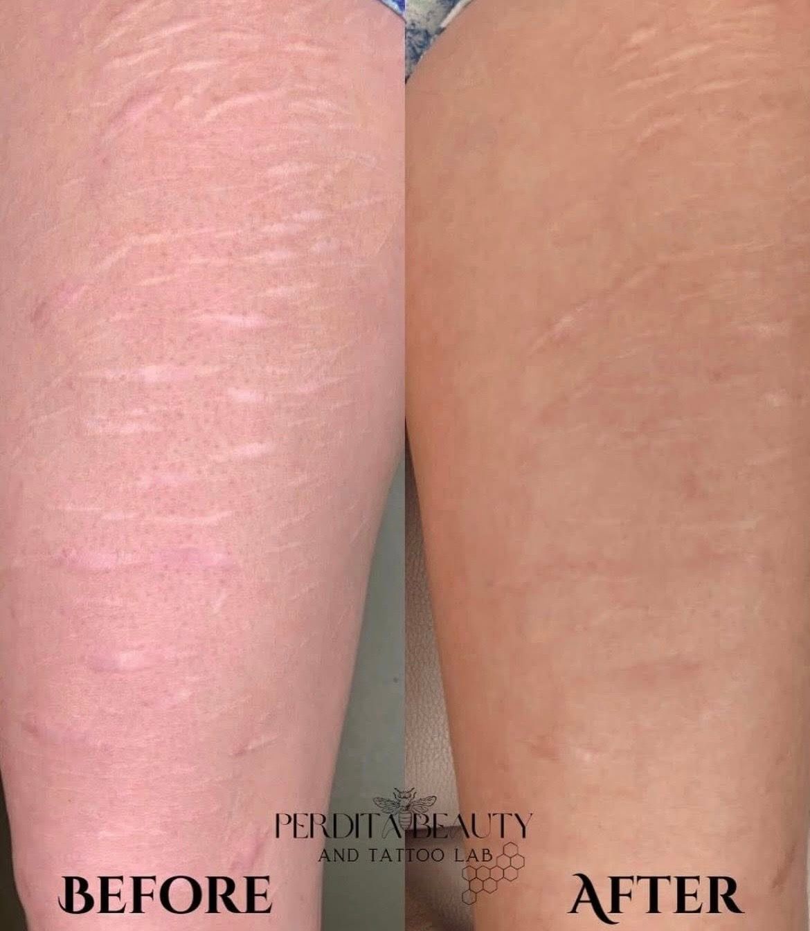 Before-and-after close-up of skin showing reduced redness and smoother texture after treatment