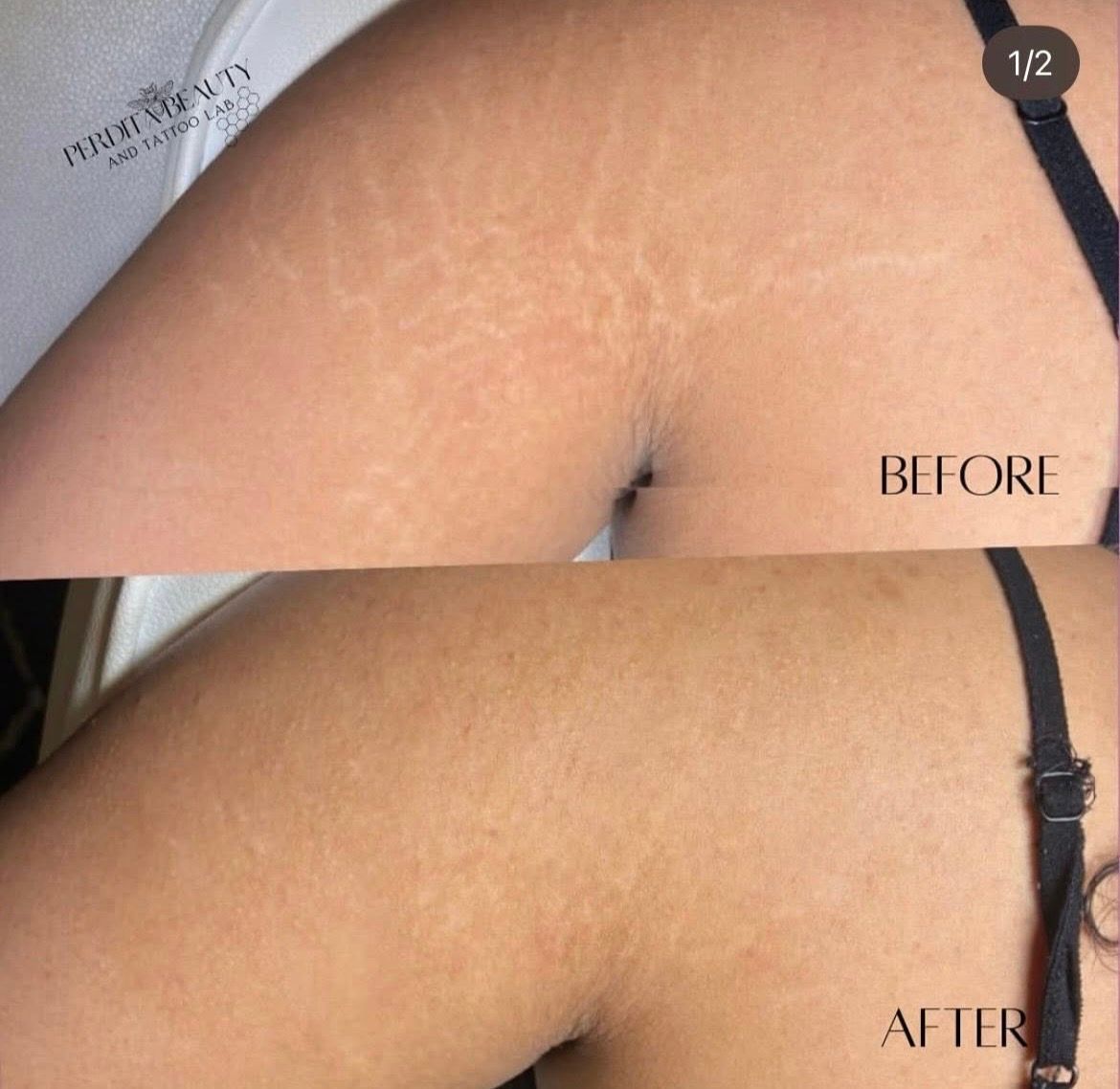 Before-and-after close-up of an upper arm, showing smoother skin after treatment.