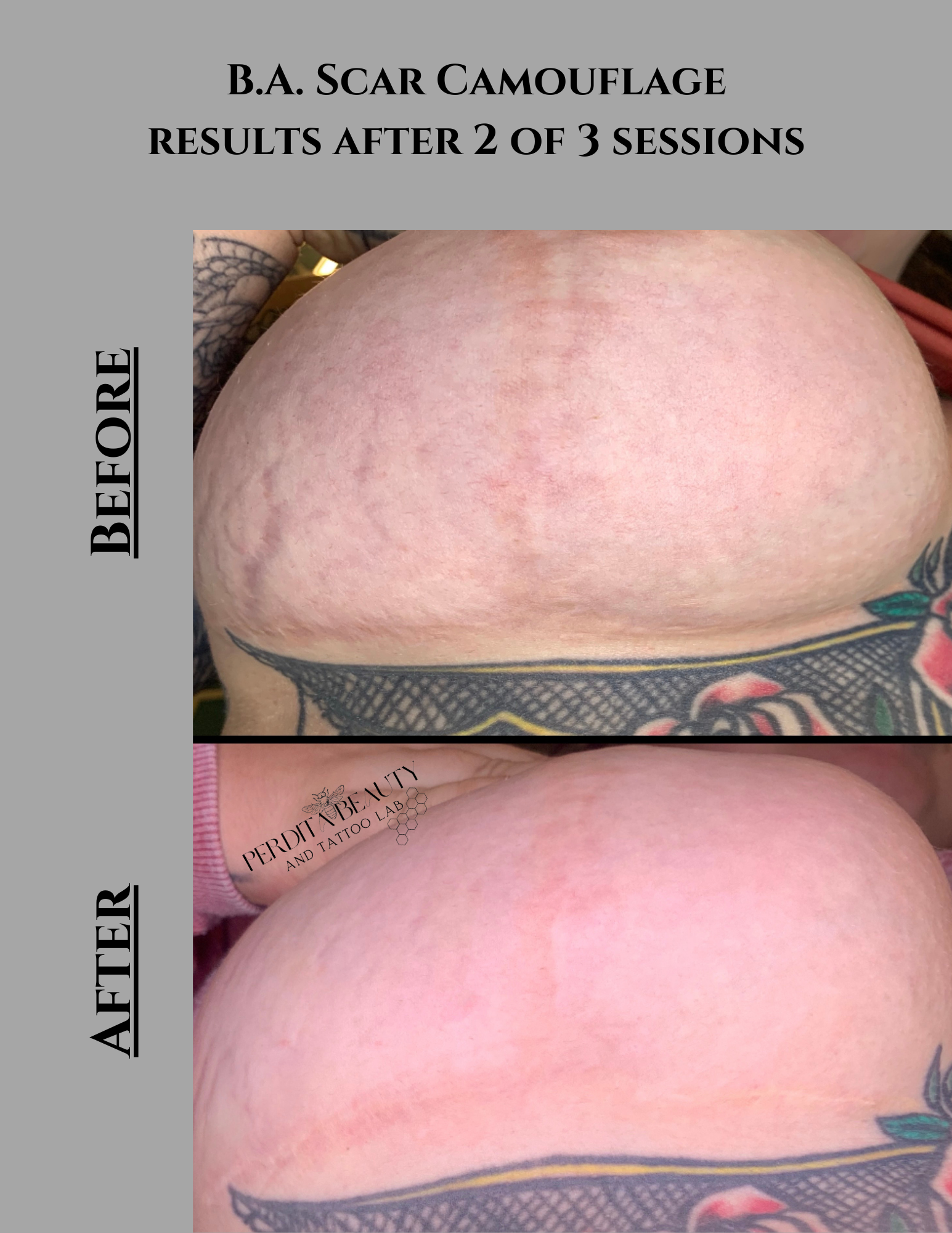 Scar camouflage results after 2 of 3 sessions